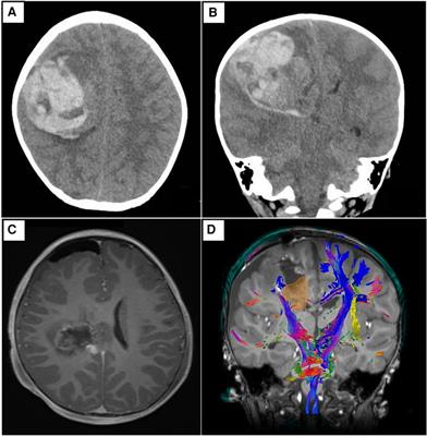 Pleomorphic xanthoastrocytoma with NTRK fusion presenting as spontaneous intracranial hemorrhage—case report and literature review